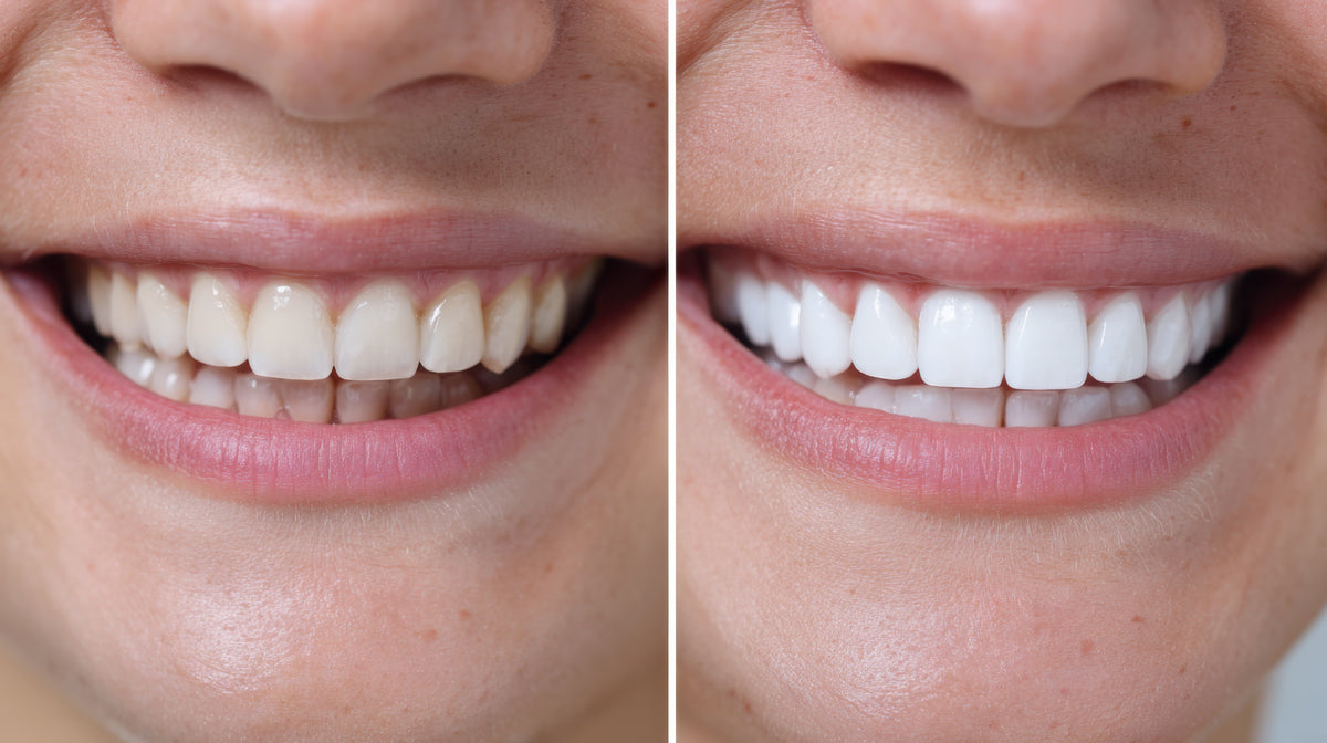 Whitening Toothpaste: Does It Work?